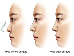 Plastic Surgery treatment in chennai