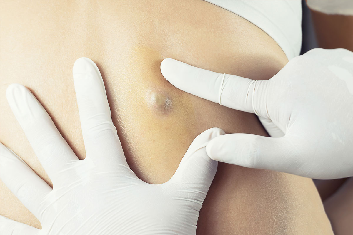 Skin grafting and reconstructive surgery