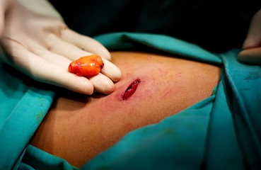Skin grafting and reconstructive surgery