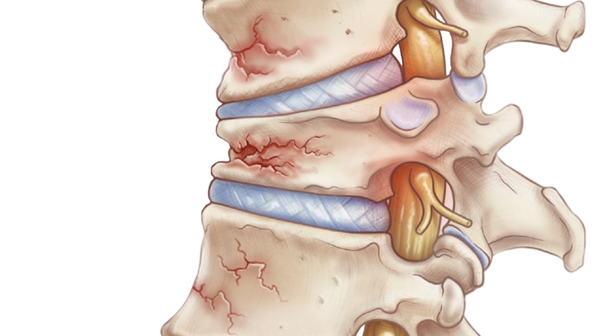Osteoporosis