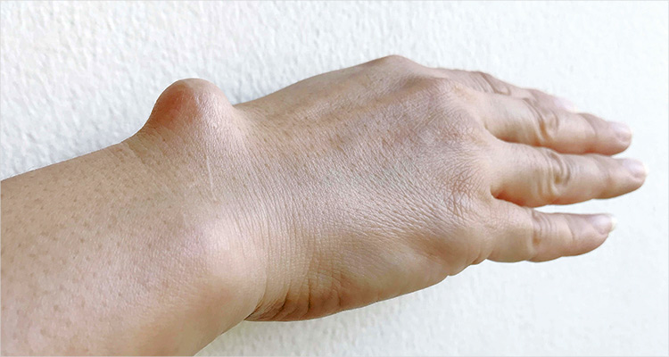 Bone Tumor