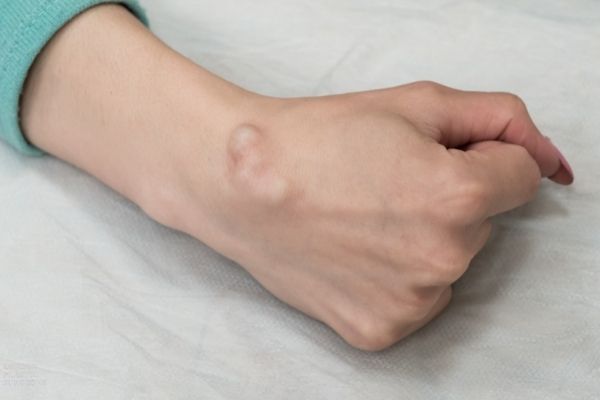 Bone Tumor