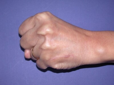 Bone Tumor