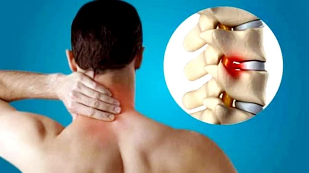 Cervical Spondylitis