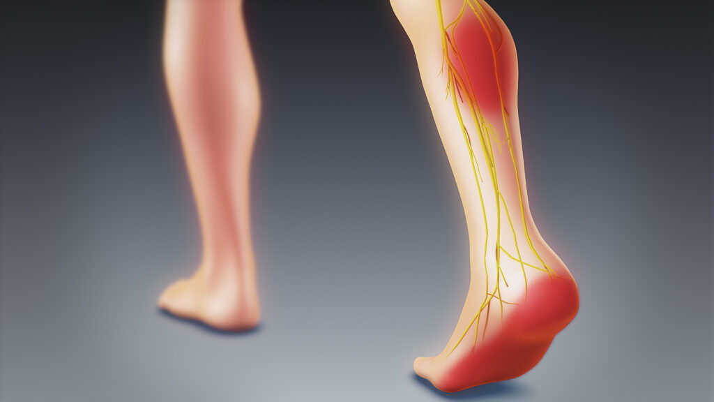 Sciatica