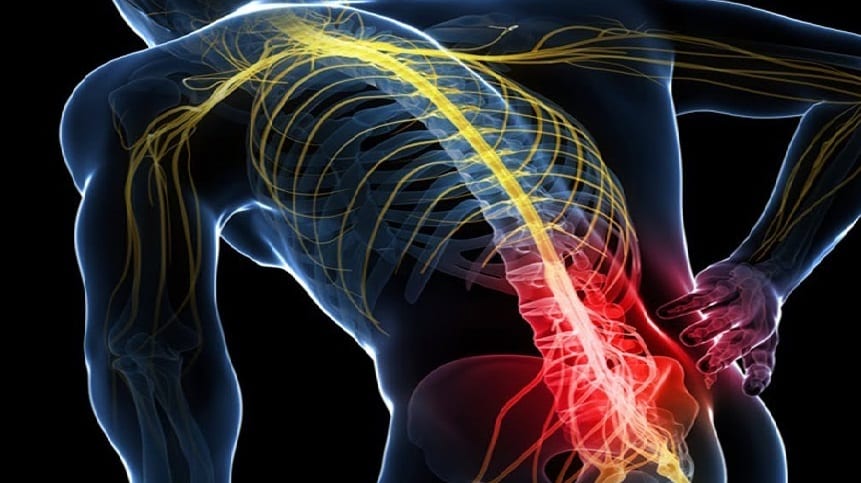 Sciatica