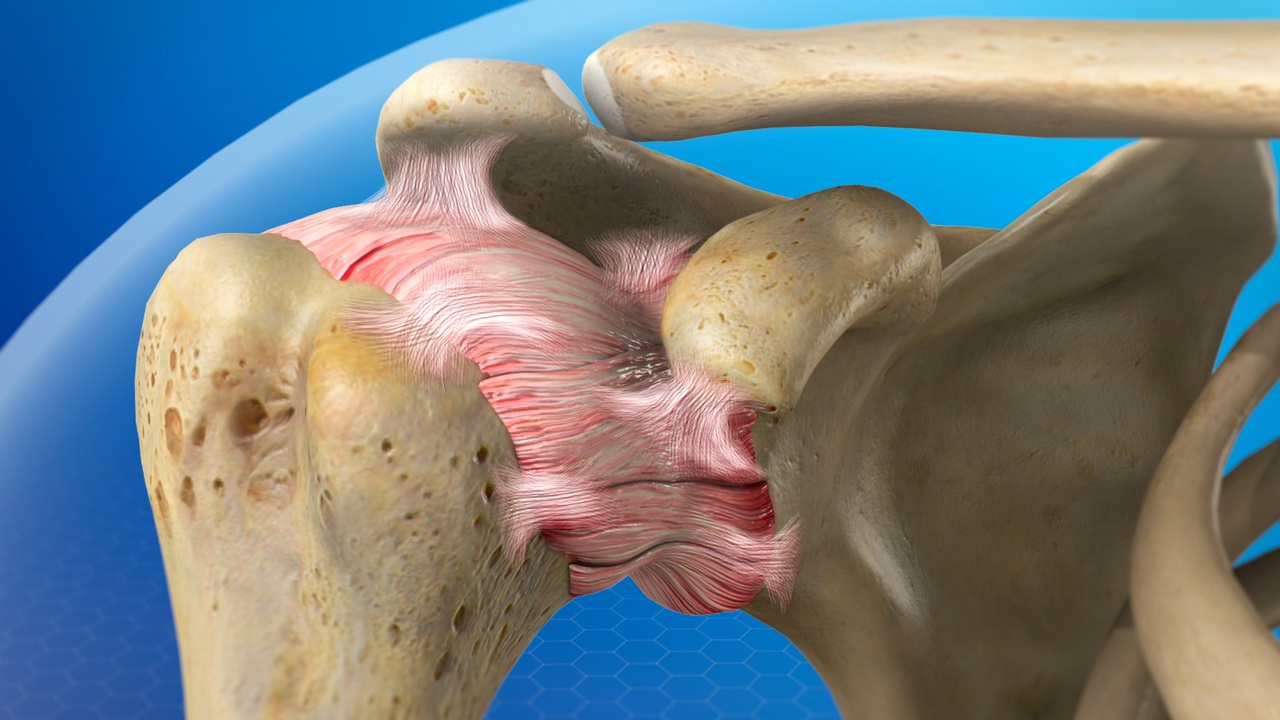 Frozen Shoulder