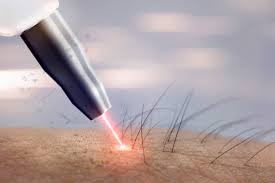 Laser Hair Reduction